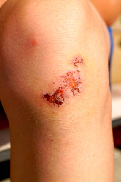 gambar lutut luka jatuh dari motor