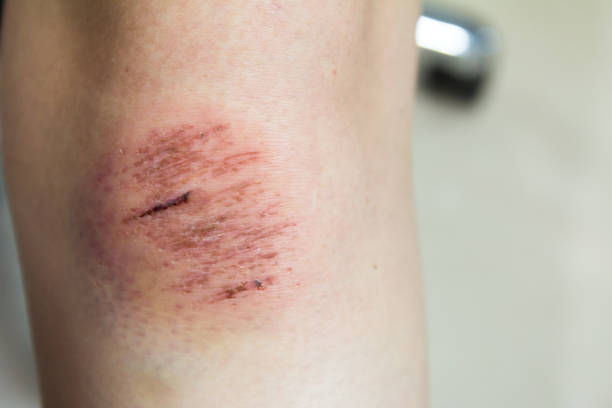 gambar lutut luka jatuh dari motor